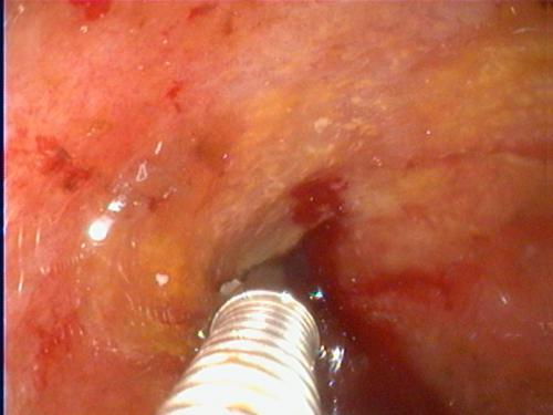 Biopsia intestinale