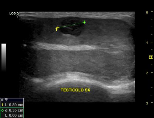 nodulo testicolare